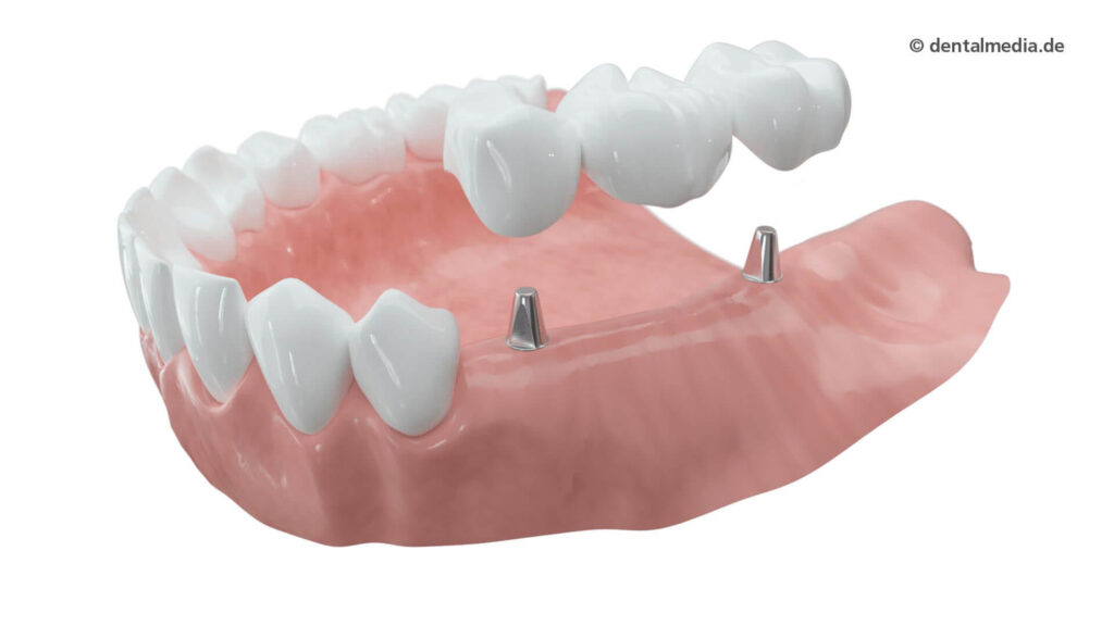 implantatgetragene Brücke